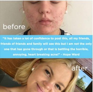 Skin B5 Extra Strength Acne Control Vitamins 60Tabs ANY 3x LESS 5% - Luxe Tribe Wellness Dispensary