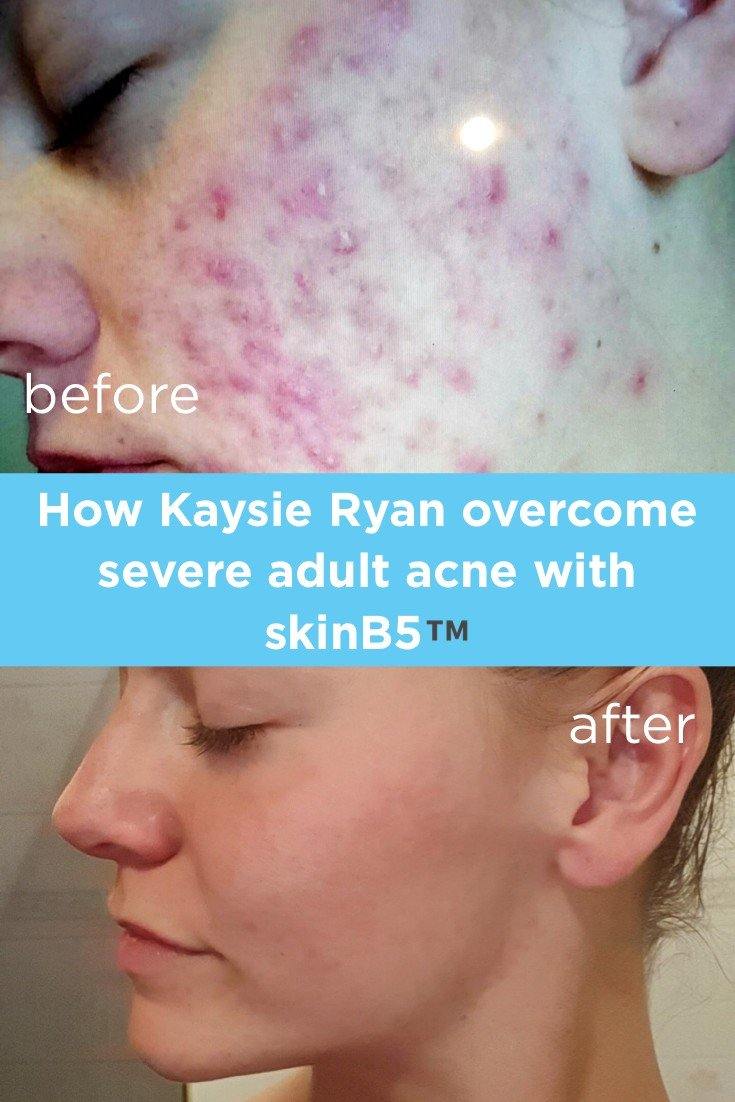 Skin B5 Extra Strength Acne Control Vitamins 60Tabs ANY 3x LESS 5% - Luxe Tribe Wellness Dispensary